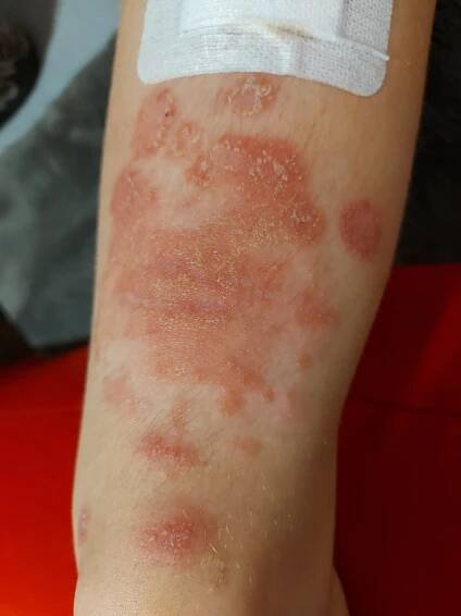 Psoriáza u 1,5 ročného dieťaťa - Modrý koník