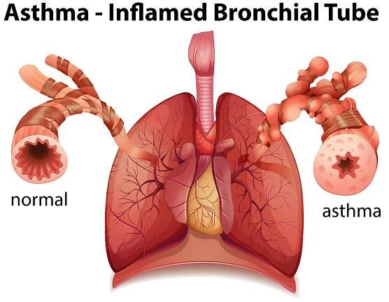 Bronchiální astma
