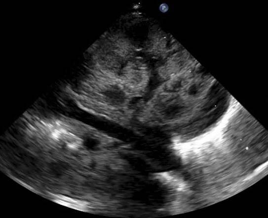 Česká Neonatologická Společnost • SIRC 2D RETRO AO