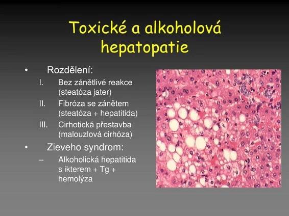 PPT - Nemoci jater a žlučníku PowerPoint Presentation, free download - ID:5513998