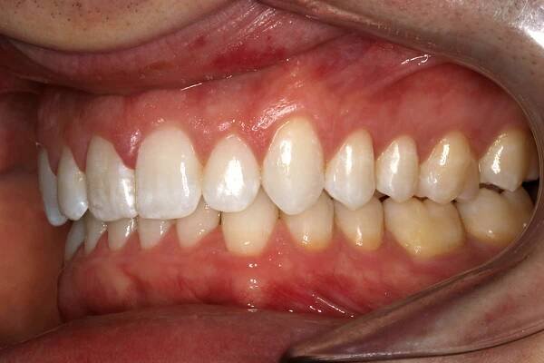 Before and After • 425 Dental
