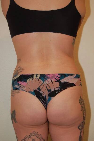 Liposuction | Umansky Plastic Surgery