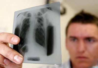 Tuberkulóza nepatrí do minulosti