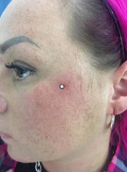 Microdermal