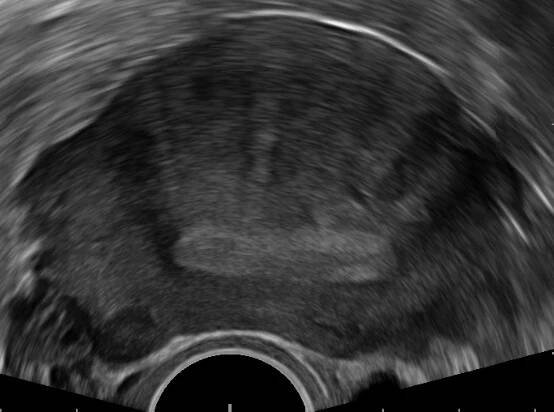 Adenomyóza – WikiSkripta