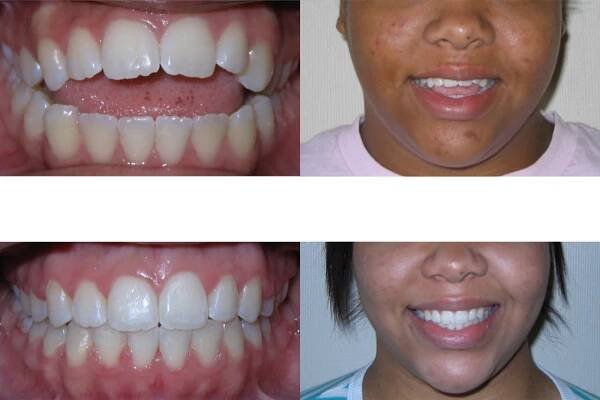 Open bite: before and after from mysmilesortho.com