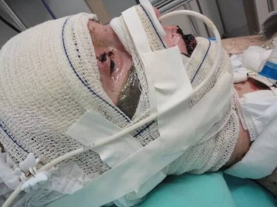 Po ibuprofenu skončila v kómatu. Žena přišla o oko a na druhé vidí jen částečně - Žena.cz