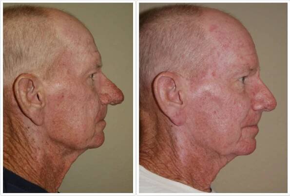 rhinophyma1