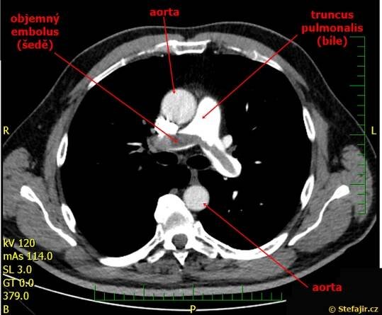 Arteria pulmonalis | Medicína, nemoci, studium na 1. LF UK