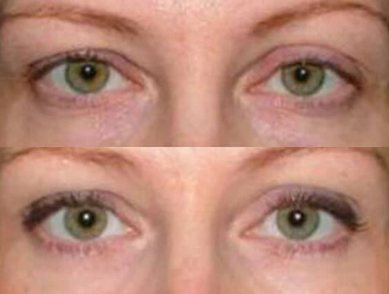 Operace očních víček v Praze. AKCE - BEAUTYSHAPE Clinic