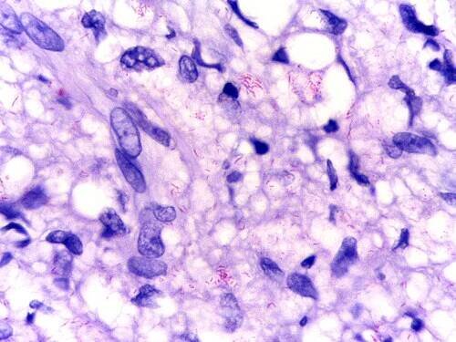 Mycobacterium leprae - Wikipedia