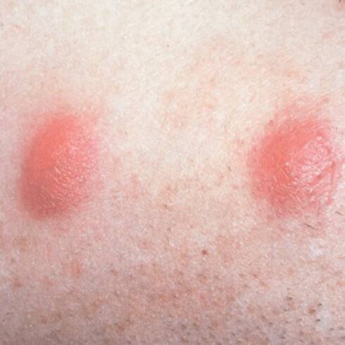 Types of Acne - Dr Terry Loong