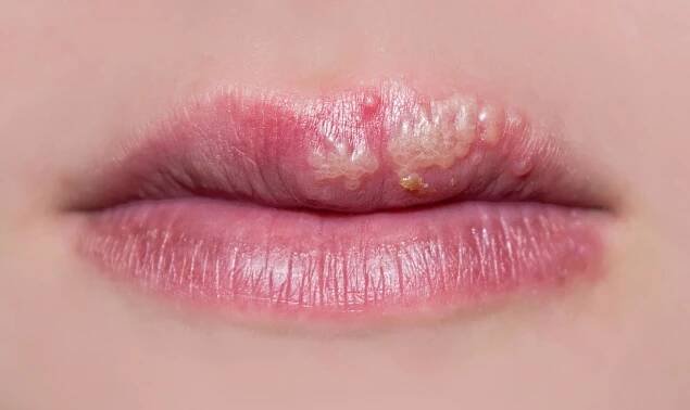 Herpes v tehotenstve