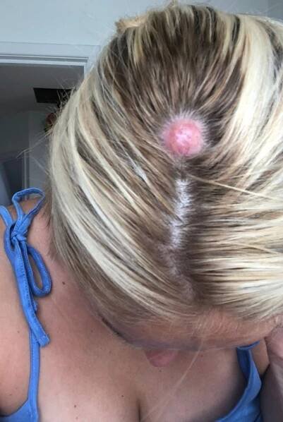 Ženě (36) závislé na solárku se na hlavě objevila bulka: Po operaci po ní zůstala obří díra!