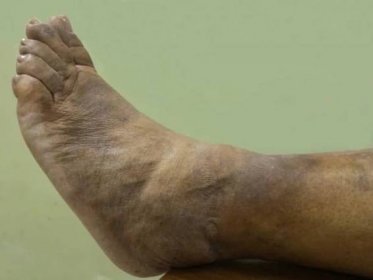 ženská noha oteklá bakteriální kožní infekcí zvanou: erysipelasova choroba je bakterie v horní vrstvě kůže. penicilinová antibiotika léčí erysipely. - erysipel vyrážka - stock snímky, obrázky a fotky