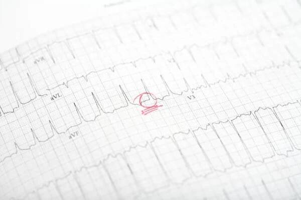 ekg - fibrilace síní - fibrilace síní - stock snímky, obrázky a fotky