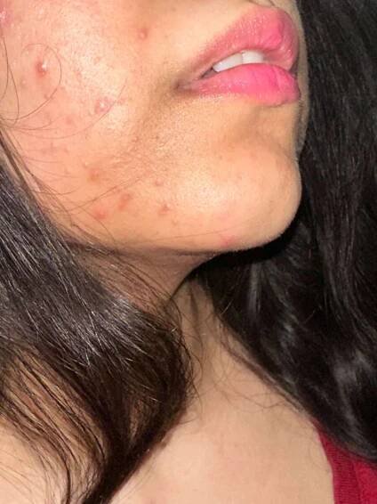 after removing nua pimple patch