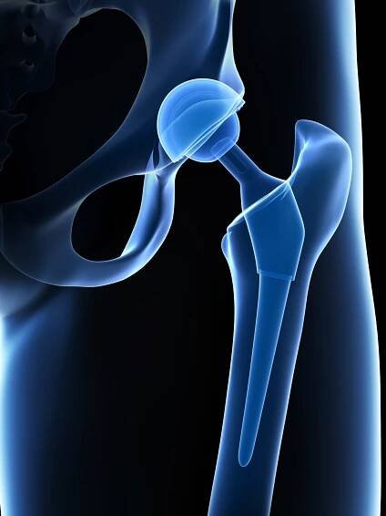 How Long Does a Total Hip Last? - International Hip Dysplasia Institute