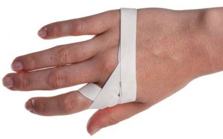 Fixace prstu pro posttraumatickou osteomyelitidu