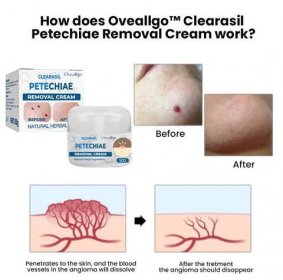 Oveallgo™ Clearasil Petechiae Removal Cream – neprodává se v obchodech