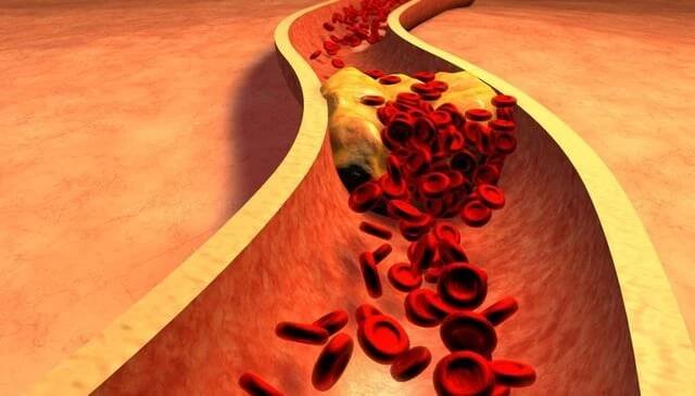 Ucpaná tepna s krevními destičkami a Cholesterol Plak — Stock obrázek