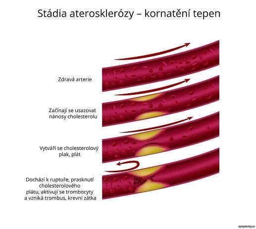 Stádia aterosklerózy - kornatění tepen