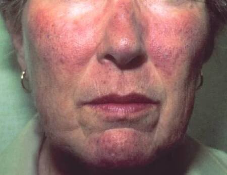 Karcinoid, karcinoidový syndrom – příznaky, projevy, symptomy - Příznaky a projevy nemocí