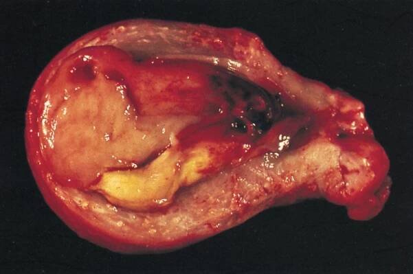 Karcinom, rakovina dělohy (těla dělohy) - příznaky, projevy, symptomy - Příznaky a projevy nemocí