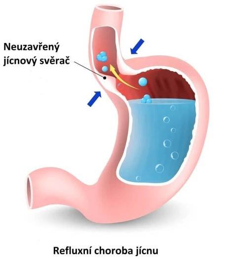Refluxní onemocnení jícnu, brániční kýla
