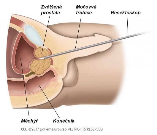 Pomočování po operaci prostaty: Jak se s tím vypořádat