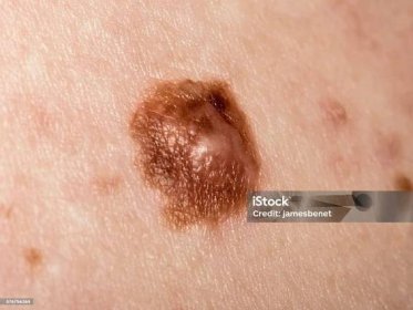 Podezřelá mole abnormální barva - Bez autorských poplatků Melanom - Rakovina kůže Stock fotka
