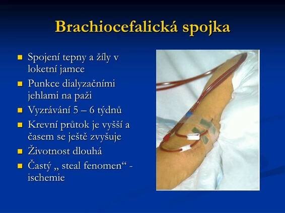 PPT - Konference se zaměřením na náhradu funkce ledvin a péči o dialyzovaného pacienta PowerPoint Presentation - ID:5673151