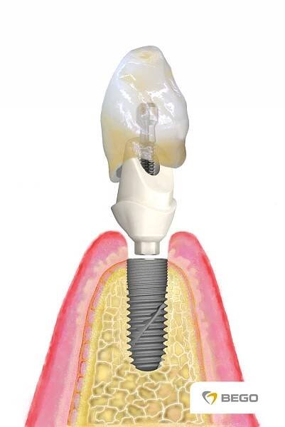 Implantáty – Komora zubních techniků ČR
