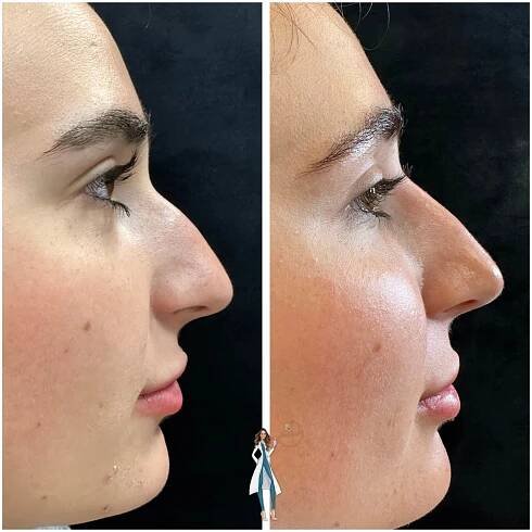 Dermal Filler Nose Before and After | SeaMist MedSpa in Rhode Island