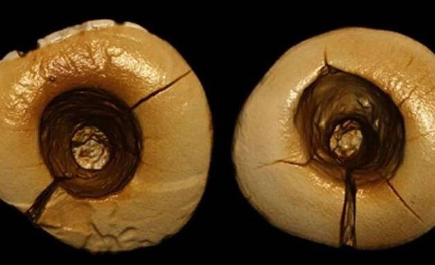 13,000-Year-Old Fillings Were “Drilled” With Stone and Packed With Tar