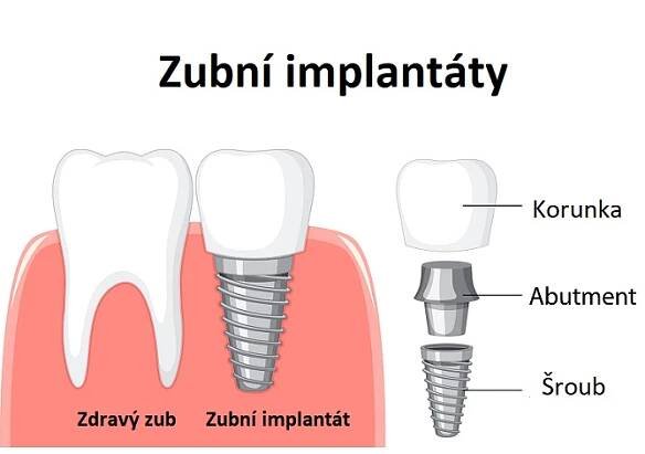Zubní implantát - ilustrace