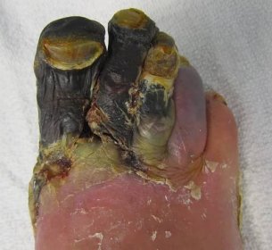 Noha při neléčené cukrovce, zdroj:commons.wikimedia.org, autor: James Heilman, MD