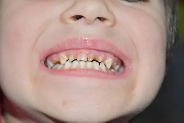 Špatné zuby v dítěti a caries, — Stock obrázek