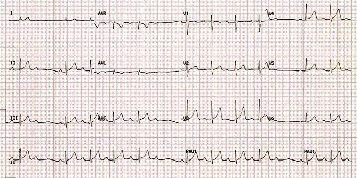 ECG second degree AV block wenckebach, Mobitz I