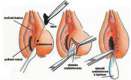 chirurgická léčba cysty Bartholiniho žlázy – schematický nákres