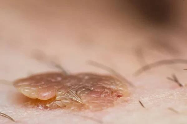 Makro fotografie kožní bradavice, papilloma virus infekce — Stock obrázek