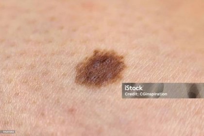 Krtek - Bez autorských poplatků Melanom - Rakovina kůže Stock fotka