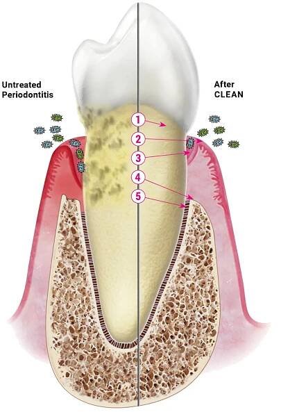 Periodontitis after CLEAN