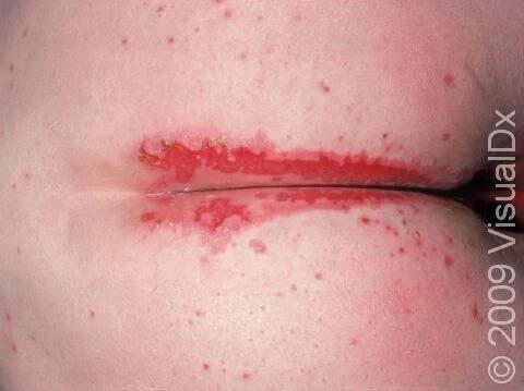 Skin erosions and superficial ulcers due to intertrigo, a skin irritation and inflammation in skin folds, are displayed.