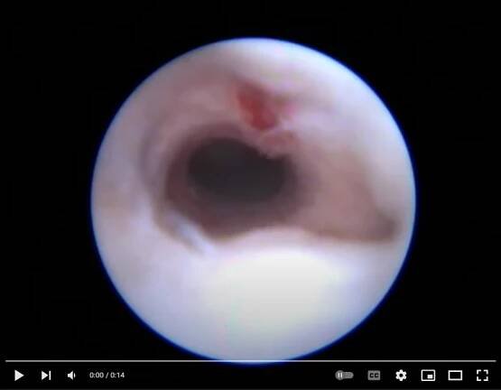 Polyp (gynekologický výraz) 