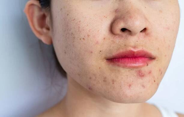 Close up of acne inflammation near mouth