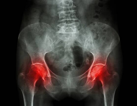 Filmový RTG pánve od artritidy a osteoporózy pacienta obou kyčlí — Stock obrázek