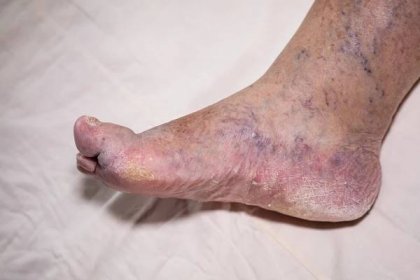 Stáhnout - Detail nemocní starší ženské oteklé nohy s poškozené prsty a nehty. — Stock obrázek