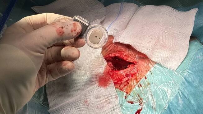 Kochleární implantát je destička o rozměrech několik málo centimetrů | foto: Ondřej Vaňura,  Český rozhlas