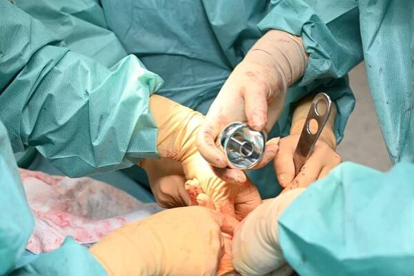 Modulární systém cervikokapitální náhrady umožňuje lékařům přesnější implantaci kyčle